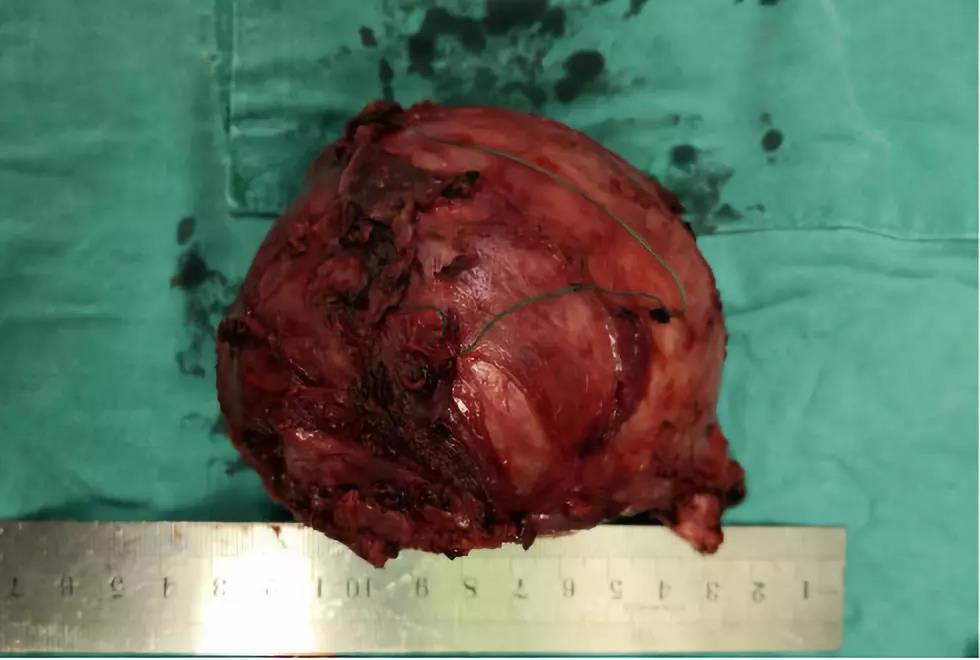 这么大的前列腺肿瘤你见过？这台手术让人震惊……