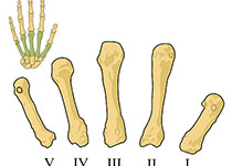 Semin Arthritis Rheu：矫正器对腕关节病的疗效