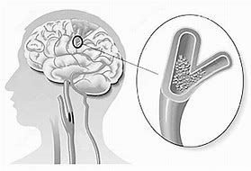 Lancet Neurol：支架再狭窄率明显高于内膜剥脱