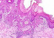 CLIN CANCER RES：AZD9496治疗<font color="red">ER</font>+/HER2-晚期乳腺癌
