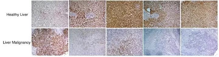 Cell：新“致癌”理论：氮代谢紊乱