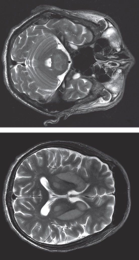 JAMA Neurol：一例“三叉戟征”患者