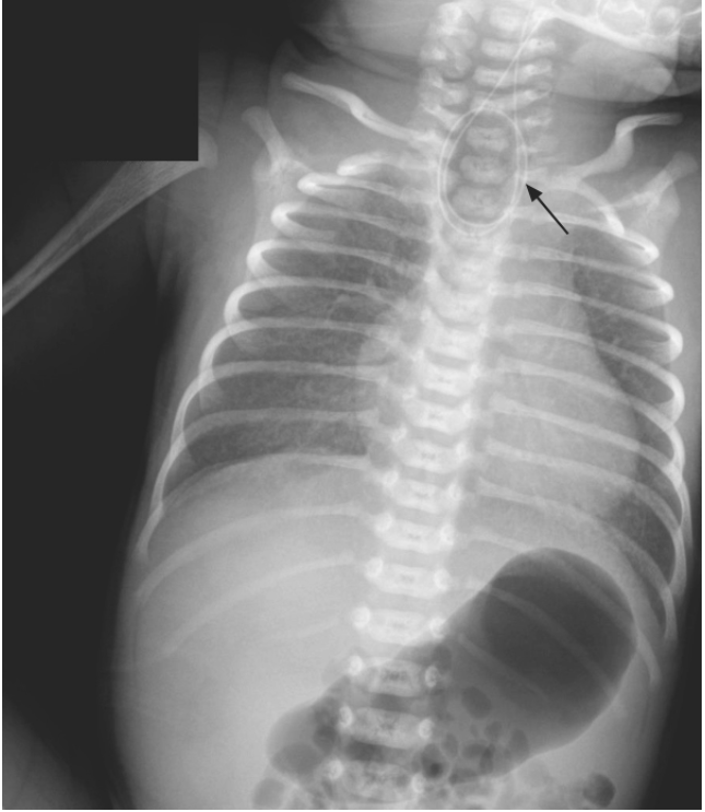 NEJM：食道闭锁伴气管食管瘘-病例报道