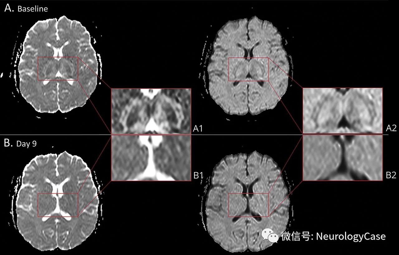 Neurology：病例:成人急性<font color="red">坏死性</font>脑病的影像学演变