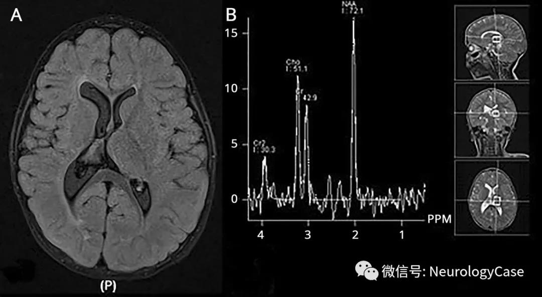 Neurology:病例：孤立的半侧丘脑过度发育