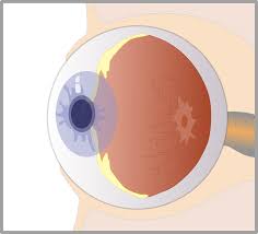 Exp Eye Res：光谱域光学相干<font color="red">断层扫描</font>的<font color="red">电子</font>显微镜结果与猪视网膜组织学的相关性