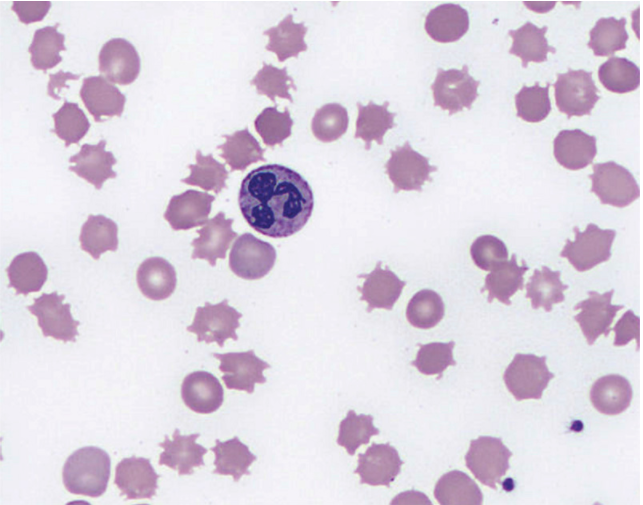 NEJM：棘突红细胞<font color="red">性贫血</font>-病例报道