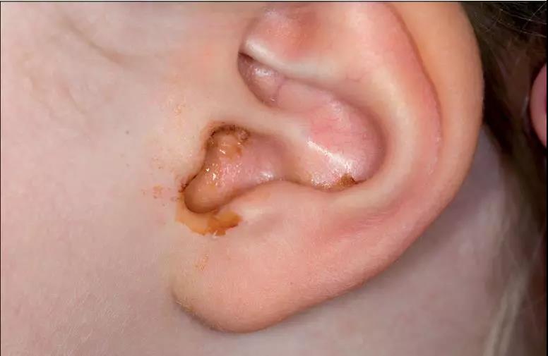Lancet：口服<font color="red">泼尼松</font>龙未能使分泌性中耳炎患者获益