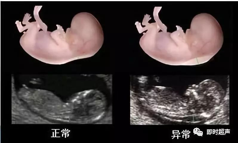 10种胎儿染色体异常的超声软指标临床解释
