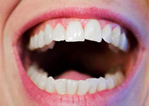 Clin Oral Invest：牙齿<font color="red">磨损</font>对口腔健康相关生活质量的影响