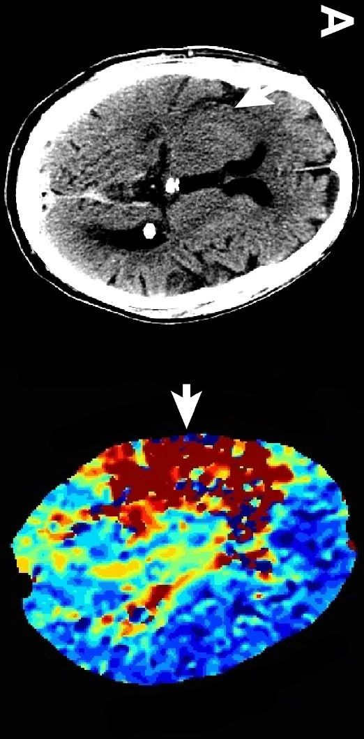 Stroke：脑静脉提前显影预测血管内<font color="red">治疗</font>后脑出血