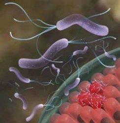 AJG： 幽门螺杆菌感染与Barrett食管风险降低相关