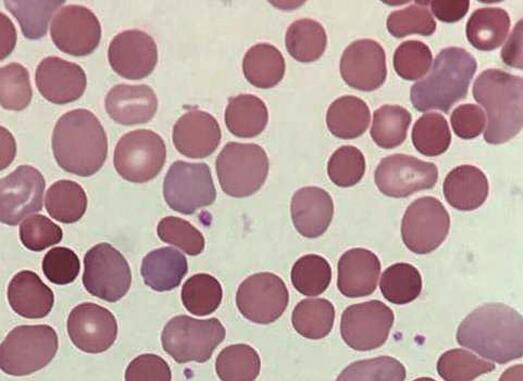 6fl,网织红细胞 (reticulocyte,ret)113%,plt 117×109/l