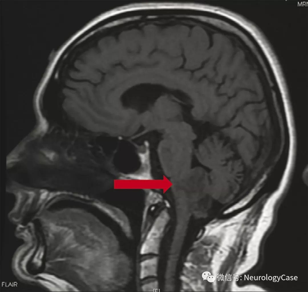 Neurology：貌似良性阵发性位置性眩晕的四脑室室<font color="red">管</font>膜瘤