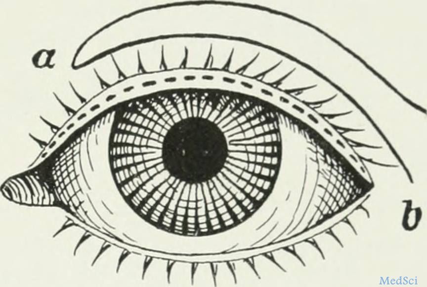 Ophthalmic Plast Reconstr Surg：关于眼眶气肿的病例报告及文献综述