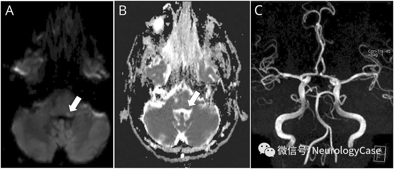 Neurology:3D T1 MRI多平面重建可见<font color="red">椎动脉</font>寰椎段夹层