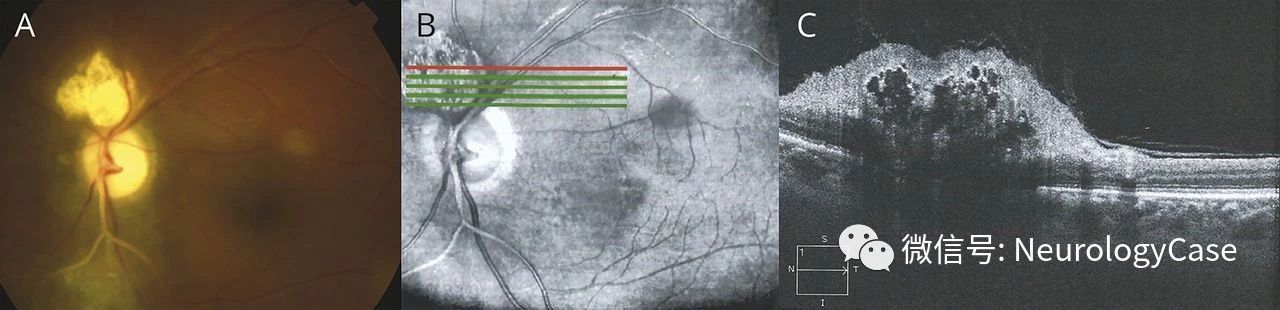 Neurology：见于结节性硬化症的Marcus-Gunn瞳孔