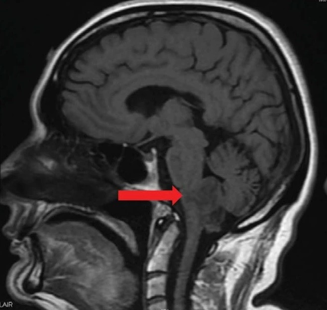 Neurology：<font color="red">被</font>误诊为BPPV的四脑室室管<font color="red">膜</font>瘤