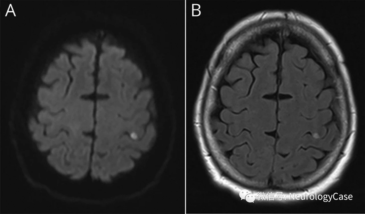 Neurology：病例：表现为孤立对侧周围性面神经麻痹的中央前<font color="red">回</font>梗死