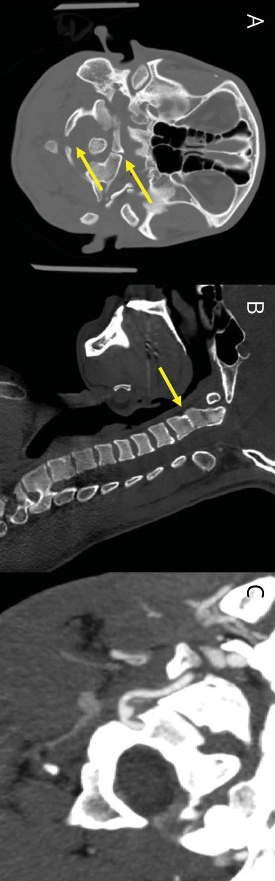 Neurology：Bow <font color="red">hunter</font>综合征致后循环卒中1例