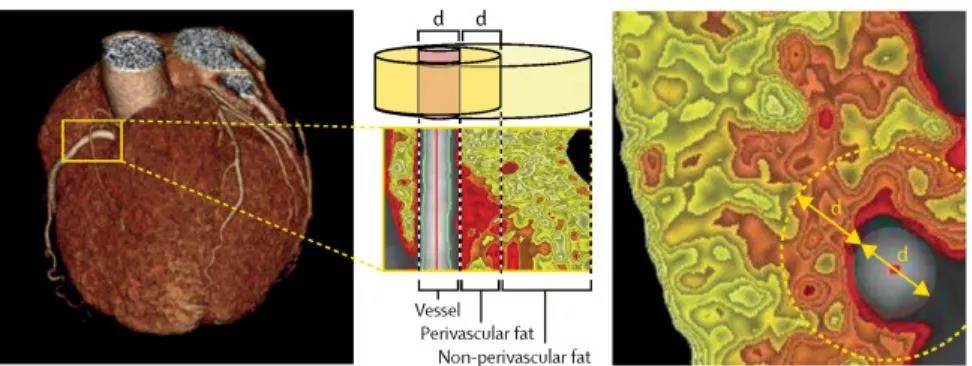 Lancet：CT造影冠脉周围脂肪衰减指数可预测心血管事件风险