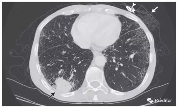 NEJM：肺部鳞状细胞癌个案一例