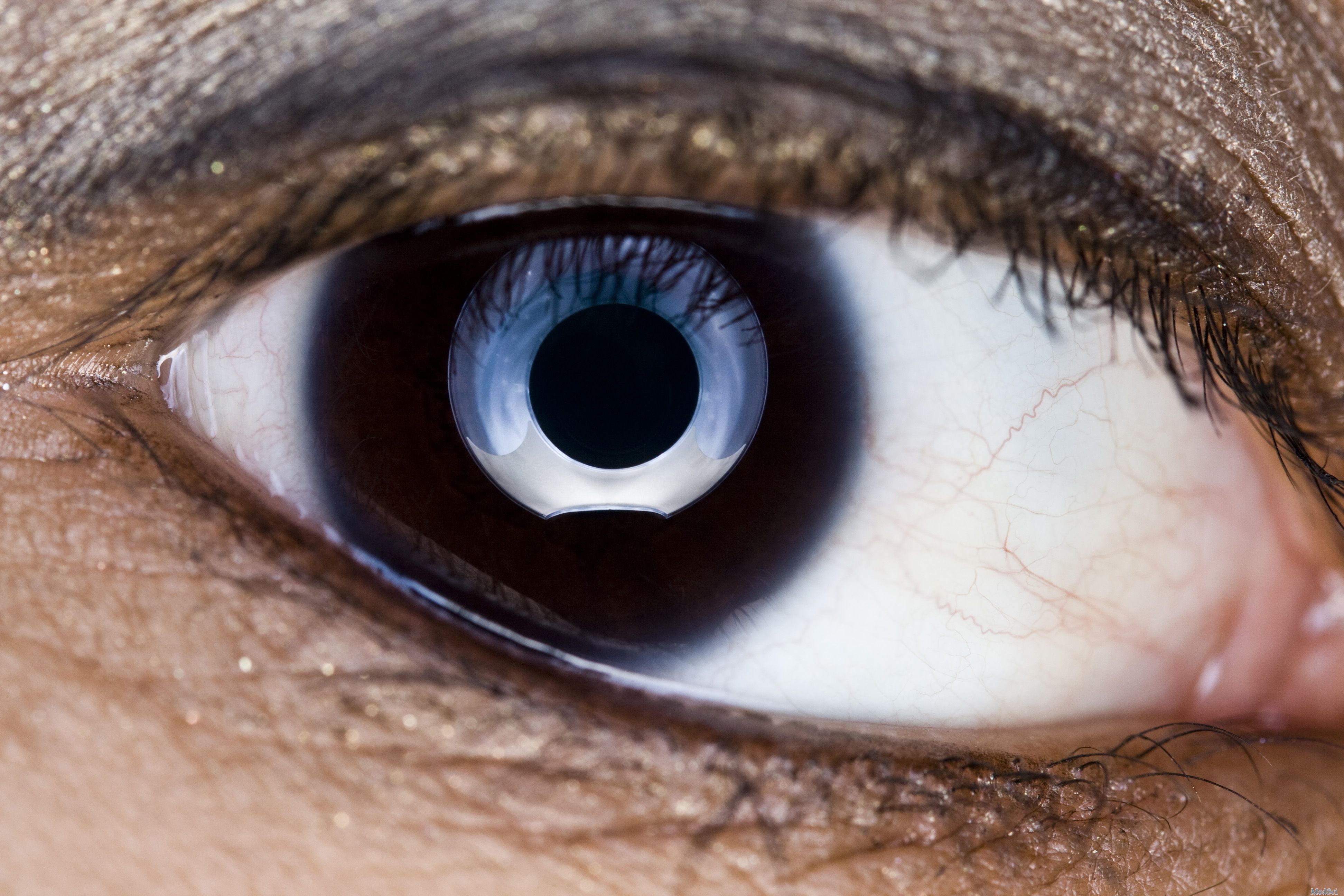 Ophthalmic Plast Reconstr Surg：眼眶粘液<font color="red">纤维</font>肉瘤的病例报告和文献综述