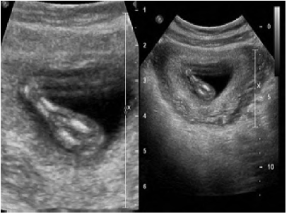 早孕期超声诊断人体鱼序列综合征1例