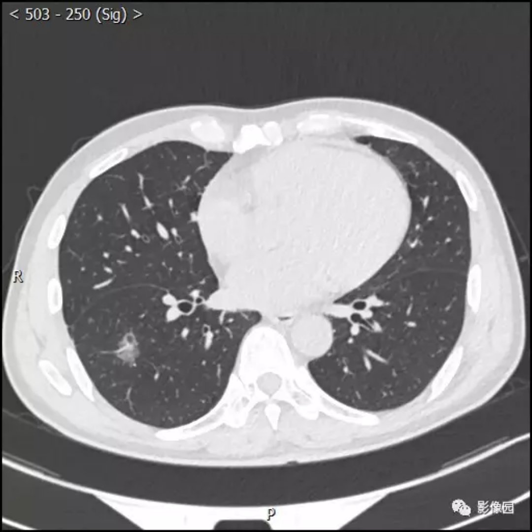 周围型肺癌CT图片