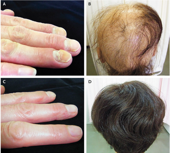 NEJM：甲状腺功能减退症引起的脆性指甲和脱发-病例报道