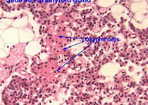 Blood：在分子上，前体B细胞表型的IG-MYC阳性肿瘤与<font color="red">伯基特淋巴瘤</font>明显不同