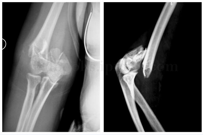 肱骨远端骨折手术 鹰嘴截骨入路or游离肱三头肌腱远端两侧入路 Medsci Cn