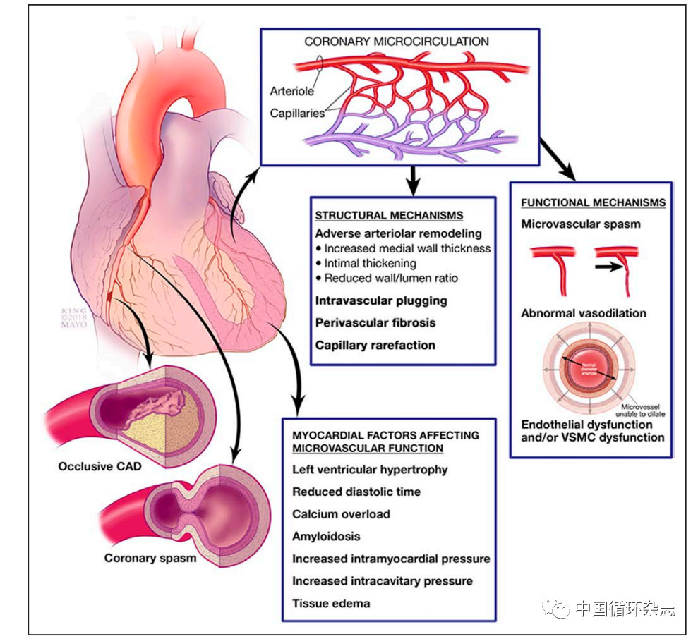 Circulation：<font color="red">微血管病变</font>在心肌缺血起关键作用：分为4型，用4条标准可诊断