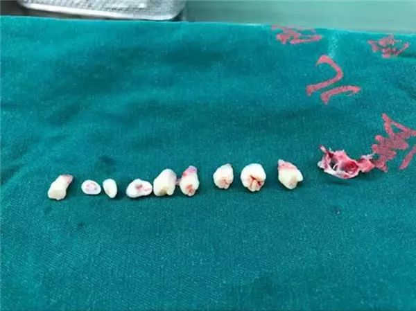 五岁男童<font color="red">摔跤</font>后头疼呕吐，医生竟从他脑袋里取出9颗牙齿！