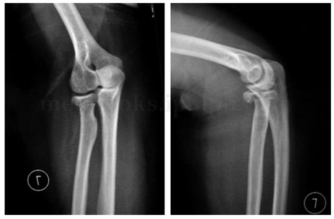 桡骨头骨折 恢复肘关节功能哪种手术优势尽显 Medsci Cn
