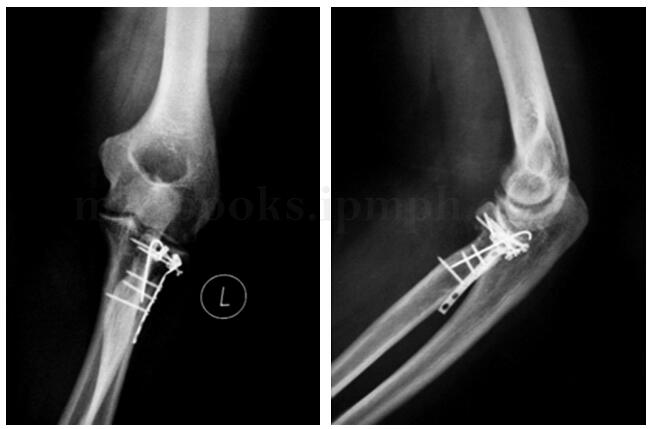 桡骨头骨折 恢复肘关节功能哪种手术优势尽显 Medsci