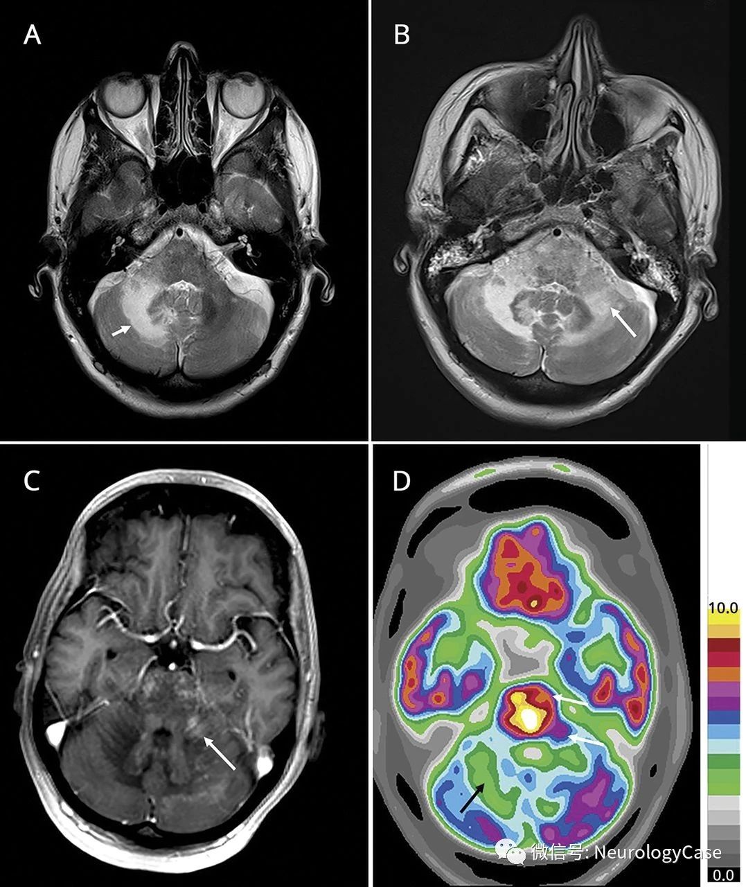 Neurology：FDG-PET成像有助于那他<font color="red">珠</font><font color="red">单抗</font>治疗患者PML-IRIS和PML的鉴别