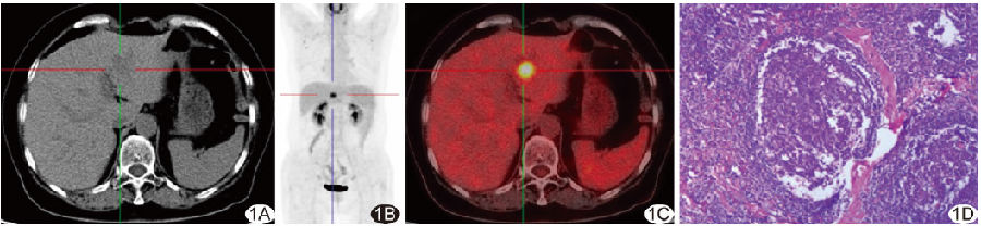 肝脏局灶型巨<font color="red">淋巴结</font><font color="red">增生</font>症的18F-FDG PET/CT表现1例