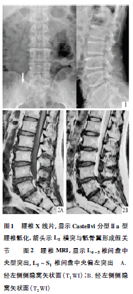 CastellviⅡa型腰椎骶化并L4～5及L5～S1椎间盘突出1例