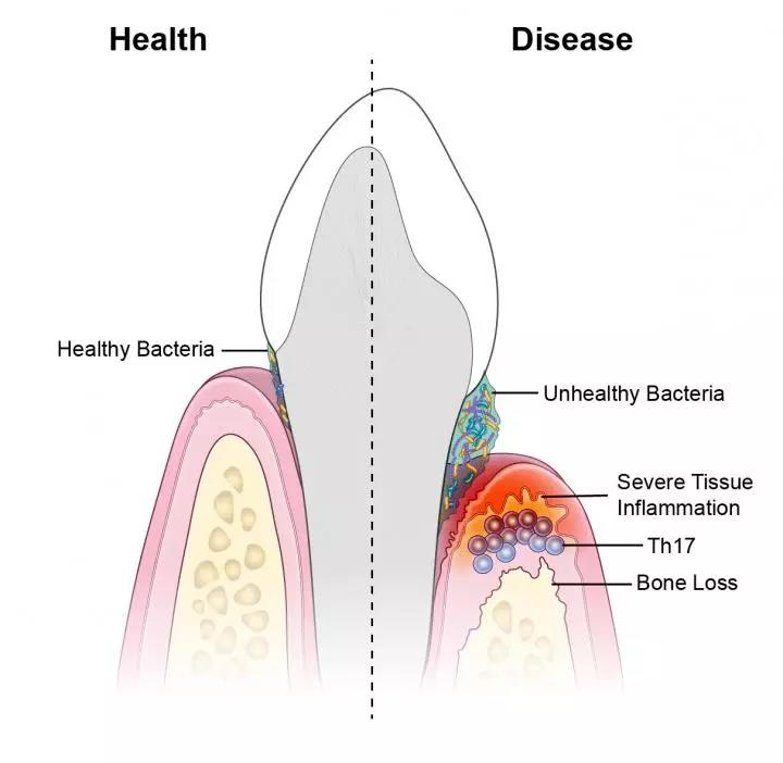 Sci Transl Med：牙龈疾病与骨质疏松有什么关系？