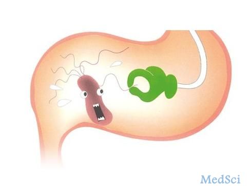 J Gastroenterology：胃MALT淋巴瘤分期为<font color="red">IE</font>和II1E的患者接受顺序幽门螺杆菌根除可以减少放射治疗的剂量