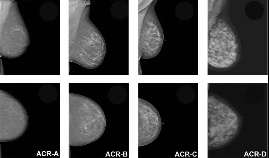 临床研究表明3D钼靶是目前最准确的乳腺癌筛查方法，能比<font color="red">常规</font>筛查多发现34%的乳腺癌