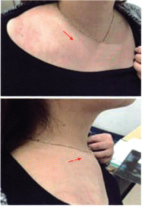 图4  病例2就诊时右侧锁骨,胸锁关节处肿胀,压痛,见红色箭头所指图5