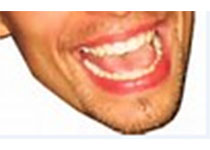 Dent Mater J：3维<font color="red">有限元</font>分析基于咬合力的靠近临牙牙根的迷你种植体的稳定性评估