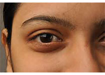 Am J Ophthalmol Case Rep：重症肌无力患者出现双<font color="red">侧</font>假性核间性眼肌麻痹