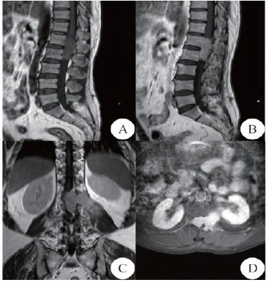 腰椎管内哑铃型血管外皮瘤1例