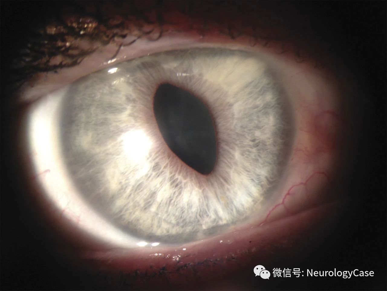 Neurology：不<font color="red">寻常</font>的Adie样瞳孔：猫眼瞳孔