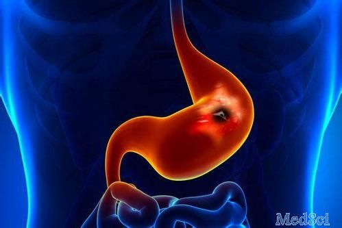 J Gastroenterology：HER2变异会对HER2阳性胃癌患者接受曲妥珠单抗疗效产生影响