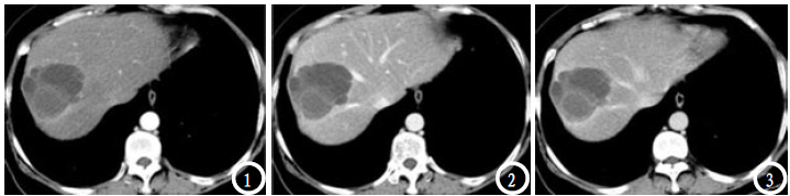 肝囊肿伴局部海绵状血管瘤变一例