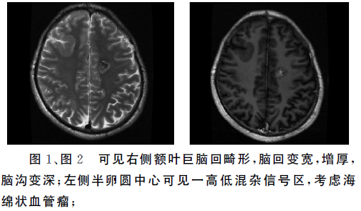 巨脑回致癫痫1例报告及临床分析